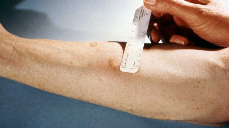 TB test